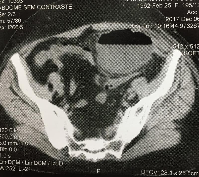 Diverticulite aguda com abscesso