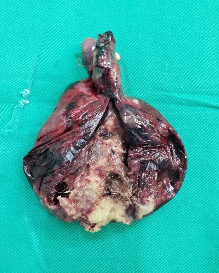 Torção de teratoma de ovário